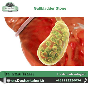 gallbladder stone